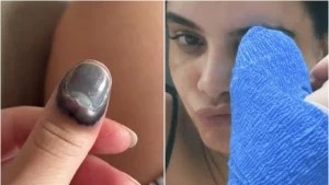 Carol Macedo sofre acidente e passa por cirurgia após levar o dedo na porta de seu carro